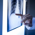 Tumore al polmone, nuova MRI individua lesioni sotto un millimetro